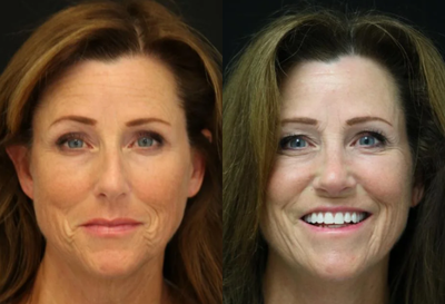 Rhinoplasty before and after photo