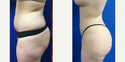 Brazilian Butt Lift before and after photo