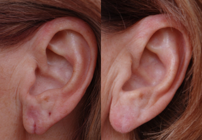 Earlobe Repair before and after photo