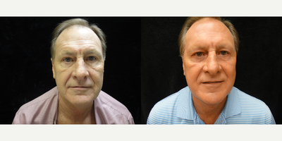Facelift before and after photo