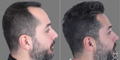 Hair Transplant before and after photo