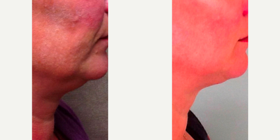 Kybella before and after photo