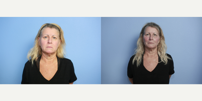 Radiesse before and after photo
