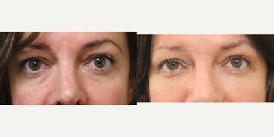 Dermal Fillers before and after photo