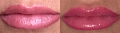 Dermal Fillers before and after photo