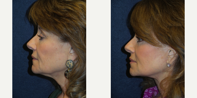 Facelift before and after photo