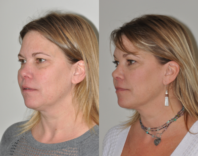 FaceTite before and after photo