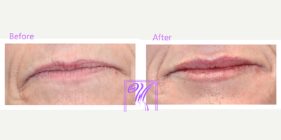 Lip Fillers before and after photo