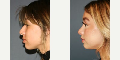 Rhinoplasty before and after photo