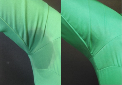 Botox for Hyperhidrosis before and after photo