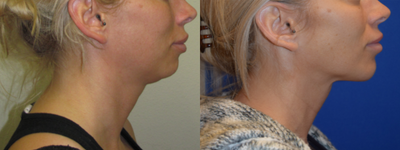 Chin Implant before and after photo