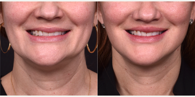 Facelift before and after photo