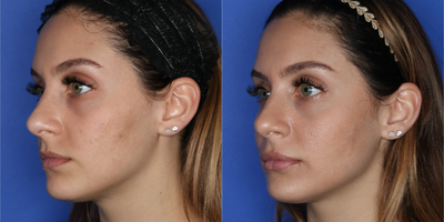 Juvederm before and after photo