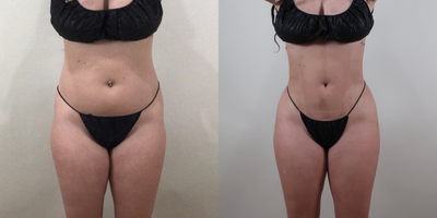 Nonsurgical Butt Lift before and after photo