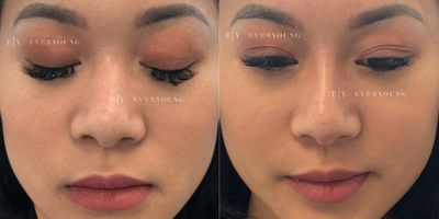 Nonsurgical Nose Job before and after photo