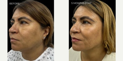 PRP Injections before and after photo