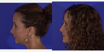 Revision Rhinoplasty before and after photo