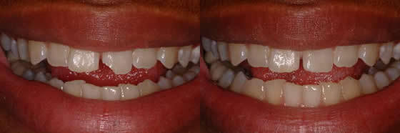 Smile Makeover before and after photo