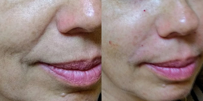 Bellafill before and after photo
