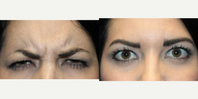 Botox before and after photo
