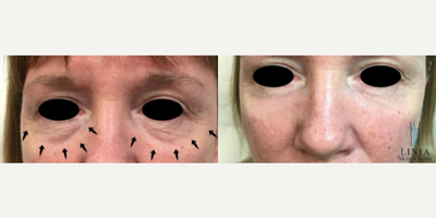 Dermal Fillers before and after photo