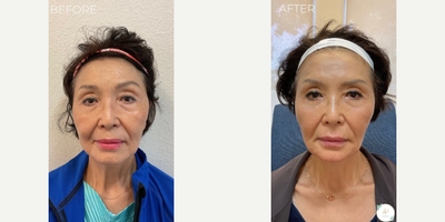 Dermal Fillers before and after photo