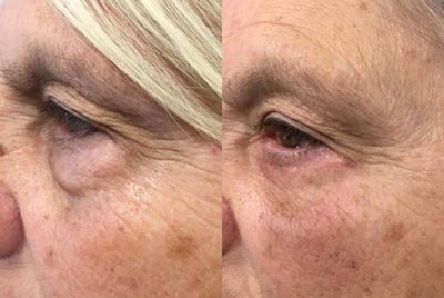 Eyelid Surgery before and after photo