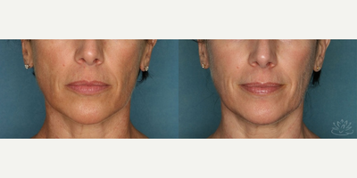 IPL before and after photo