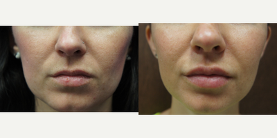 Juvederm before and after photo