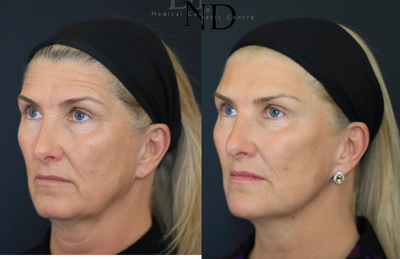 Juvederm before and after photo