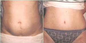 Tummy Tuck before and after photo