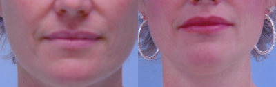 Lip Fillers before and after photo