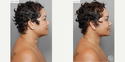 Neck Lift before and after photo