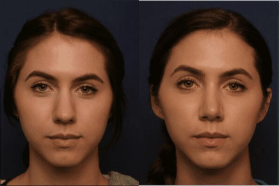 Rhinoplasty before and after photo