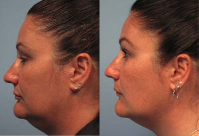 Exilis before and after photo