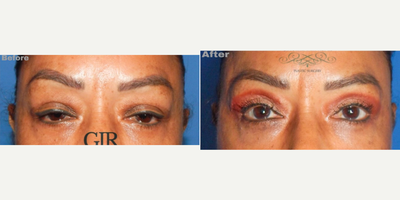 Eyelid Surgery before and after photo