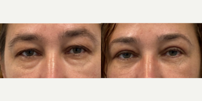 Eyelid Surgery before and after photo