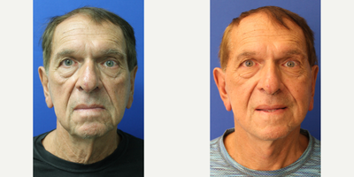 Facelift before and after photo