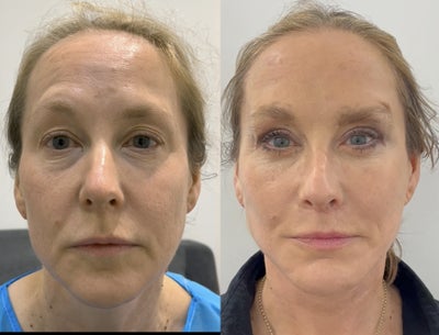 Facelift before and after photo