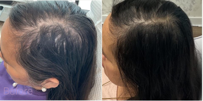 PRP for Hair Loss before and after photo