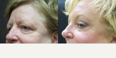 Eyelid Surgery before and after photo