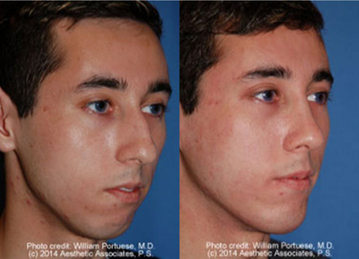 Genioplasty before and after photo