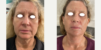 Morpheus8 before and after photo