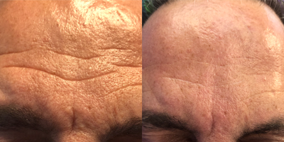 Thermage before and after photo