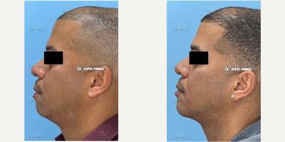 Chin Implant before and after photo