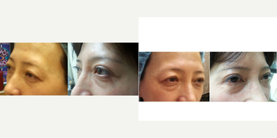 Double Eyelid Surgery before and after photo
