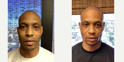 Eyelid Surgery before and after photo