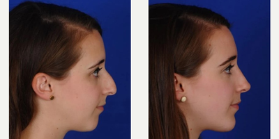 Rhinoplasty before and after photo
