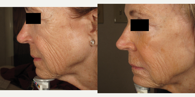 Ultherapy before and after photo