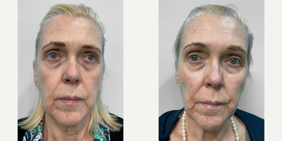 Botox before and after photo
